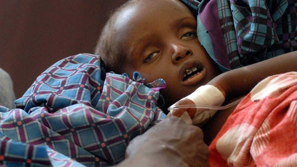 Vakavasti aliravittu lapsi Somalian Mogadishussa vuonna 2011, jolloin alueella kärsittiin vakavasta kuivuudesta.