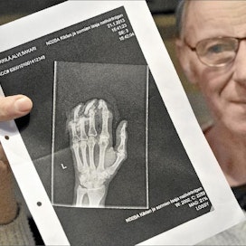Alvi Sakari Heikkilä näyttää röntgenkuvaa hammasrattaan vaurioittamista sormista. Harri Nurminen