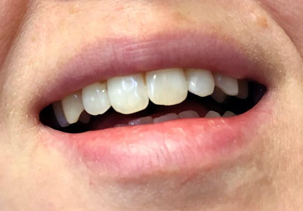 Hammaslääkäri varoittaa: Hapan kasvisruoka pehmentää hampaiden pintoja -  Ruoka - Maaseudun Tulevaisuus