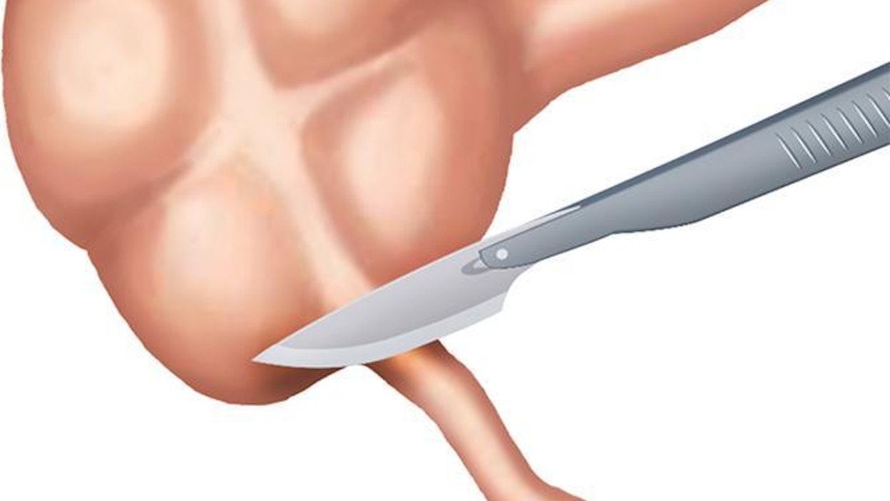 Matomainen umpilisäke sijaitsee paksusuolen alkupäässä.