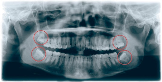 Viisaudenhampaat puhkeavat usein vain osittain näkyviin. Tilanpuutteen vuoksi ne saattavat olla kallellaan.