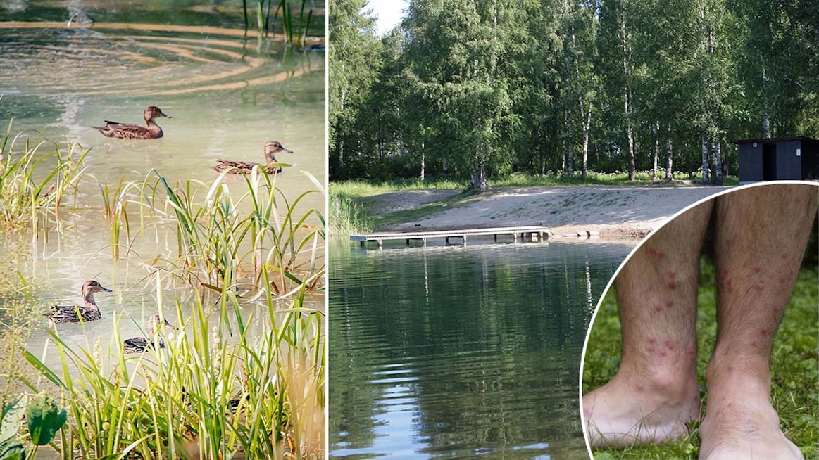 Ihmisen iholle eksynyt imumadon toukka kuolee nopeasti, mutta kutina voi jatkua useita päiviä. Imumato on vesilintujen loinen.