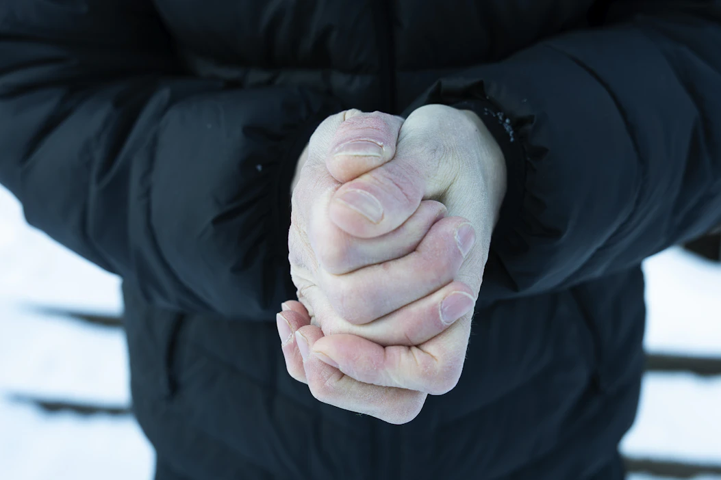 Lievät paleltumat voi hoitaa itse kotona. Paleltunutta kohtaa voi sulatella lämpimässä vedessä.