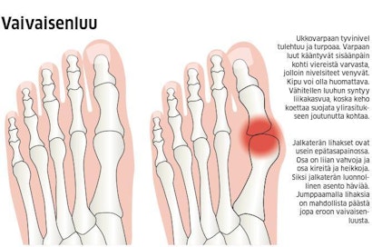 Kipu tuntuu yleensä eniten vaivaisenluun varhaisvaiheessa.