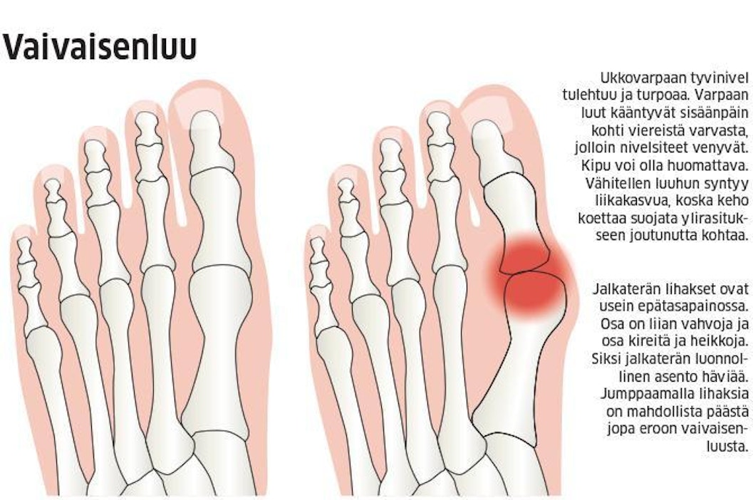 Kipu tuntuu yleensä eniten vaivaisenluun varhaisvaiheessa.