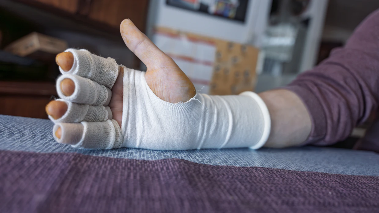 Käsi on vaatinut jo kaksi leikkausta. Lisäksi sitä seurataan noin viikon välein kuukauden ajan Tromssassa Pohjois-Norjan yliopistollisessa sairaalassa.