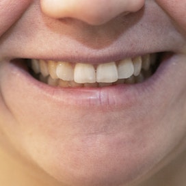 Hampaiden yhteen pureminen on perinnöllistä, mutta esimerkiksi stressi ja alkoholinkäyttö voivat pahentaa vaivaa.